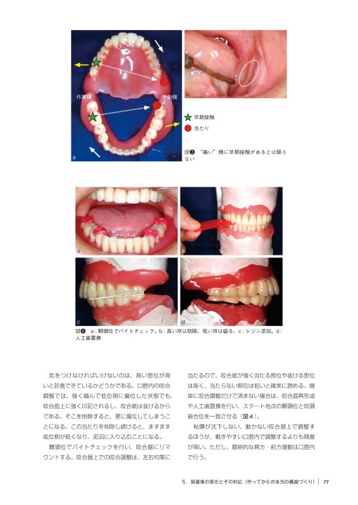 食べる喜びを支える歯科医療のためのデンチャースペース義歯