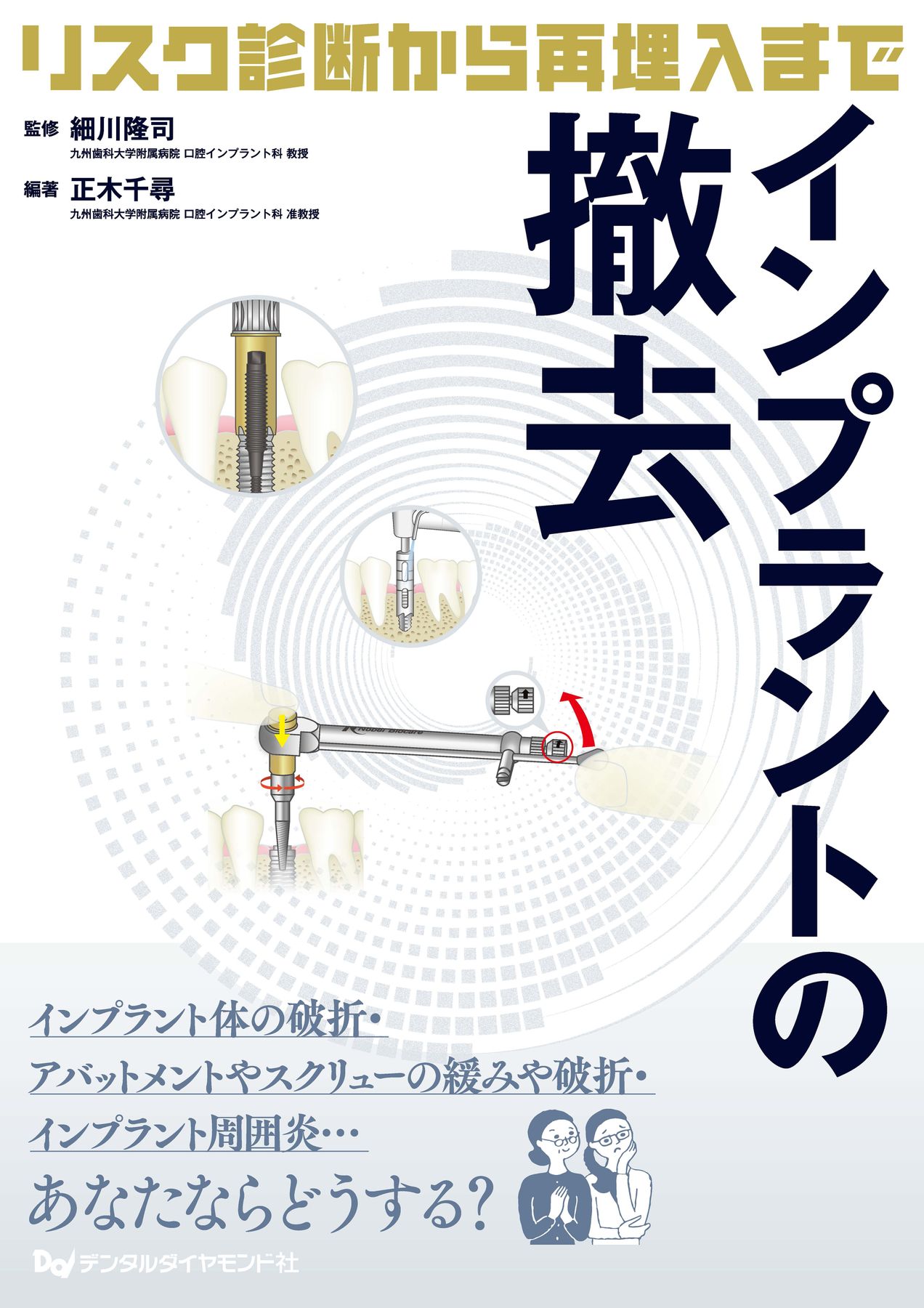 インプラントの撤去 ～リスク診断から再埋入まで～