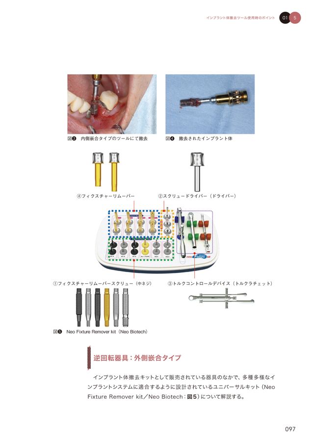 お歳暮 インプラントの撤去 ～リスク診断から再埋入まで～ 健康/医学