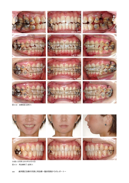 歯列矯正治療の失敗と再治療 : 臨床現場からのレポート - 健康/医学