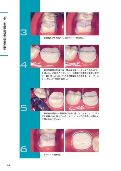 支台歯形成のベーシックテクニック