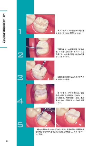 支台歯形成のベーシックテクニック